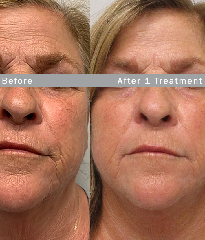 Non-Surgical Fat Loss & Skin Tightening at Phoenix Cosmetic Centre